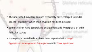 • The unerupted maxillary canines frequently have enlarged follicular
spaces , especially when their eruption has been delayed
• Some children have generalized enlargement and hyperplasia of their
follicular spaces
• Hyperplastic dental follicles have been reported with rough
hypoplastic amelogenesis imperfecta and in Lowe syndrome
 