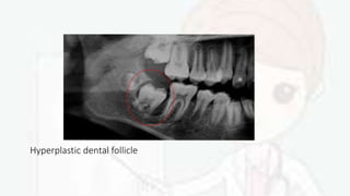 Hyperplastic dental follicle
 