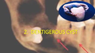 2. DENTIGEROUS CYST
 