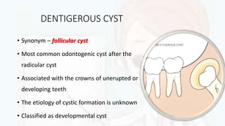 DENTIGEROUS CYST
• Synonym – follicular cyst
• Most common odontogenic cyst after the
radicular cyst
• Associated with the crowns of unerupted or
developing teeth
• The etiology of cystic formation is unknown
• Classified as developmental cyst
 