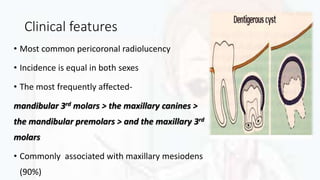 Clinical features
• Most common pericoronal radiolucency
• Incidence is equal in both sexes
• The most frequently affected-
mandibular 3rd molars > the maxillary canines >
the mandibular premolars > and the maxillary 3rd
molars
• Commonly associated with maxillary mesiodens
(90%)
 