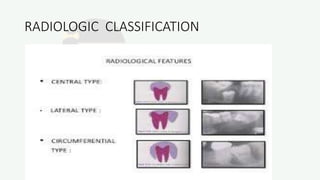 RADIOLOGIC CLASSIFICATION
 
