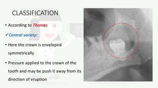 CLASSIFICATION
• According to Thomas
Central variety:
• Here the crown is enveloped
symmetrically
• Pressure applied to the crown of the
tooth and may be push it away from its
direction of eruption
 
