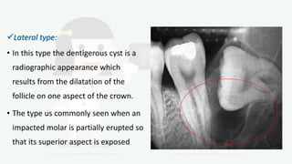 Lateral type:
• In this type the dentigerous cyst is a
radiographic appearance which
results from the dilatation of the
follicle on one aspect of the crown.
• The type us commonly seen when an
impacted molar is partially erupted so
that its superior aspect is exposed
 