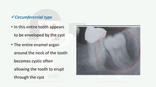 Circumferential type
• In this entire tooth appears
to be enveloped by the cyst
• The entire enamel organ
around the neck of the tooth
becomes cystic often
allowing the tooth to erupt
through the cyst
 