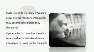 • Cysts related to maxillary 3rd molars
grow into the maxillary antrum and
may become large before they
discovered
• Cyst attached to mandibular molars
my extend a considerable distance
into ramus or lower border mandible
 
