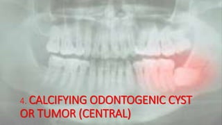 4. CALCIFYING ODONTOGENIC CYST
OR TUMOR (CENTRAL)
 