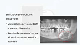 EFFECTS ON SURROUNDING
STRUCTURES
• May displace a developing tooth
or prevents its eruption
• Associated expansion of the jaw
with maintenance of a cortical
boundary
 