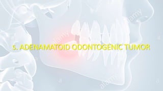 5. ADENAMATOID ODONTOGENIC TUMOR
 