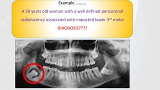 Example ……….
A 50 years old woman with a well defined pericoronal
radiolucency associated with impacted lower 3rd molar
DIAGNOSIS????
g
 