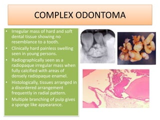 Compound Odontoma Ppt Compound Odontoma Ppt