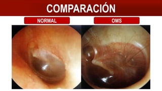 COMPARACIÓN
NORMAL OMS
 