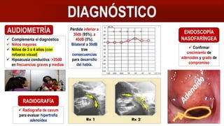 DIAGNÓSTICO
AUDIOMETRÍA
 Complementa el diagnóstico
 Niños mayores
 Niños de 3 o 4 años (con
refuerzo visual)
 Hipoacusia conductiva: >20dB
en frecuencias graves y medias
ENDOSCOPÍA
NASOFARÍNGEA
 Confirmar
crecimiento de
adenoides y grado de
compromiso
RADIOGRAFÍA
 Radiografía de cavum
para evaluar hipertrofia
adenoidea
Pérdida inferior a
30db (95%), a
40dB (5%).
Bilateral a 30dB
trae
consecuencias
para desarrollo
del habla.
 