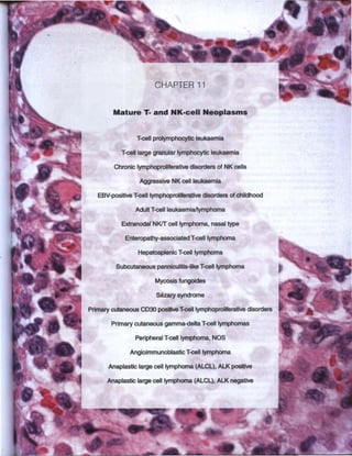 Clasificación de leucemias - OMS 2008