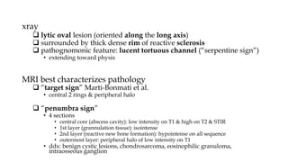 Lucent Rim Sign Osteomyelitis and Septic arthritis.pptx