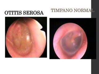 OTITIS SEROSA
TIMPANO NORMAL
 