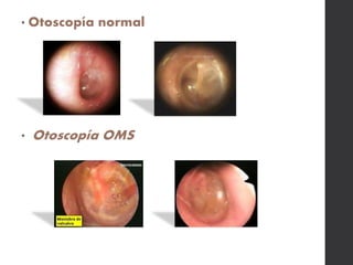 • Otoscopía normal
• Otoscopía OMS
 
