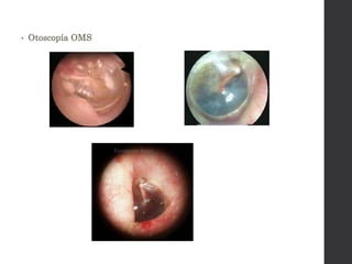 • Otoscopía OMS
 