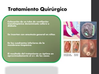 Tratamiento Quirúrgico
• Colocación de un tubo de ventilación
transtimpánico denominado collera o
diábolo.
• Se insertan con anestesia general en niños
• En los cuadrantes inferiores de la
membrana timpánica.
• El resultado del tratamiento es óptimo en
aproximadamente el 80% de los casos.
 