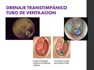 DRENAJE TRANSTIMPÁNICO
TUBO DE VENTILACION
 