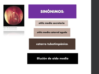 otitis media secretoria
otitis media catarral aguda
catarro tubotimpánico.
Efusión de oído medio
 