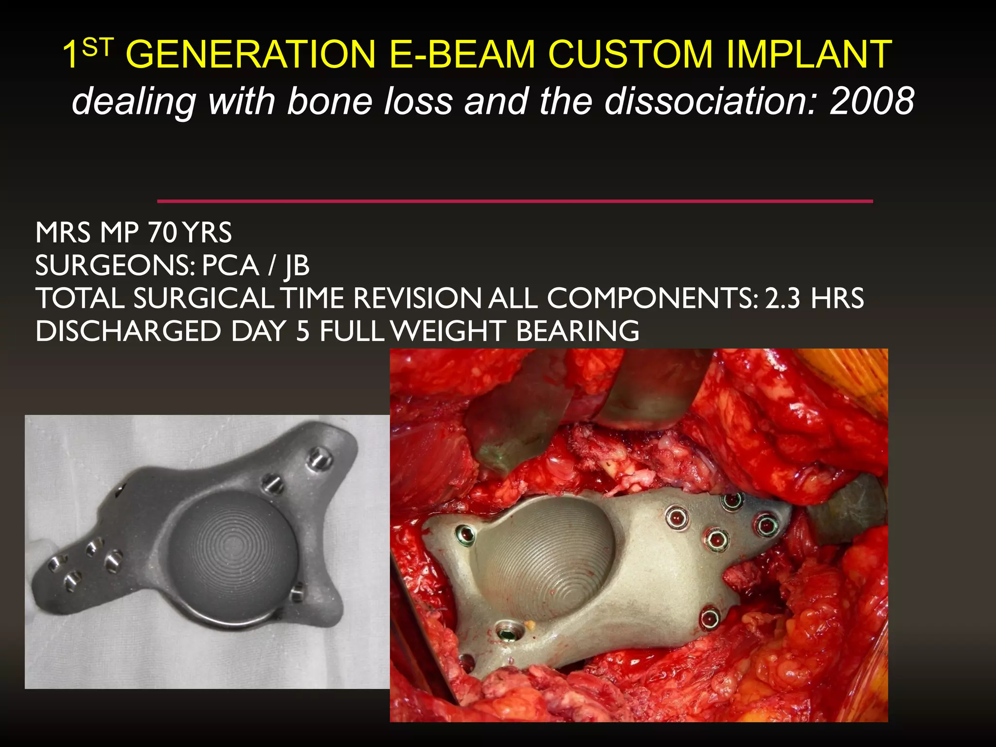 MRS MP 70YRS
SURGEONS: PCA / JB
TOTAL SURGICAL TIME REVISION ALL COMPONENTS: 2.3 HRS
DISCHARGED DAY 5 FULL WEIGHT BEARING
1ST GENERATION E-BEAM CUSTOM IMPLANT
dealing with bone loss and the dissociation: 2008
 
