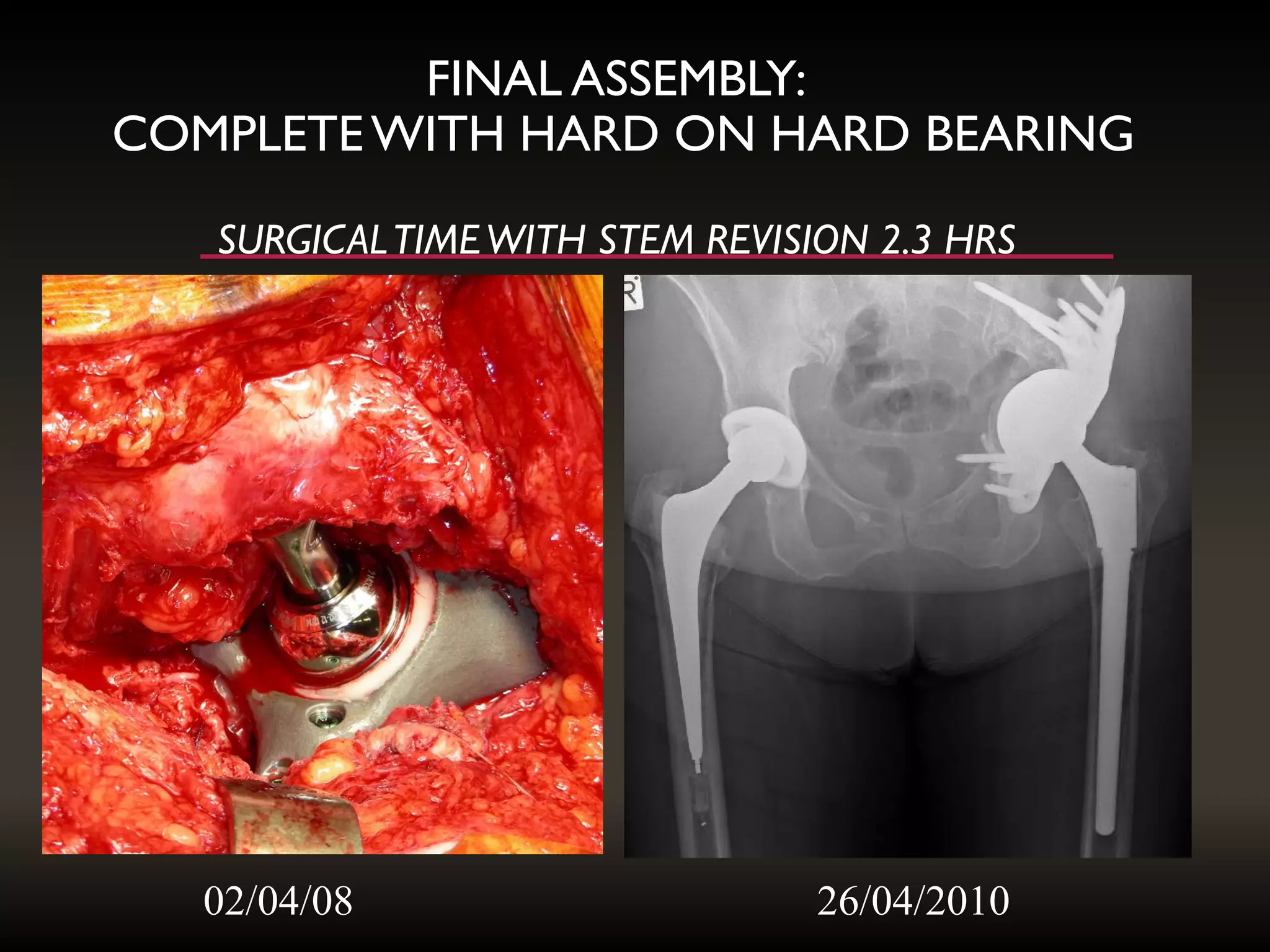 FINAL ASSEMBLY:
COMPLETEWITH HARD ON HARD BEARING
SURGICALTIMEWITH STEM REVISION 2.3 HRS
02/04/08 26/04/2010
 