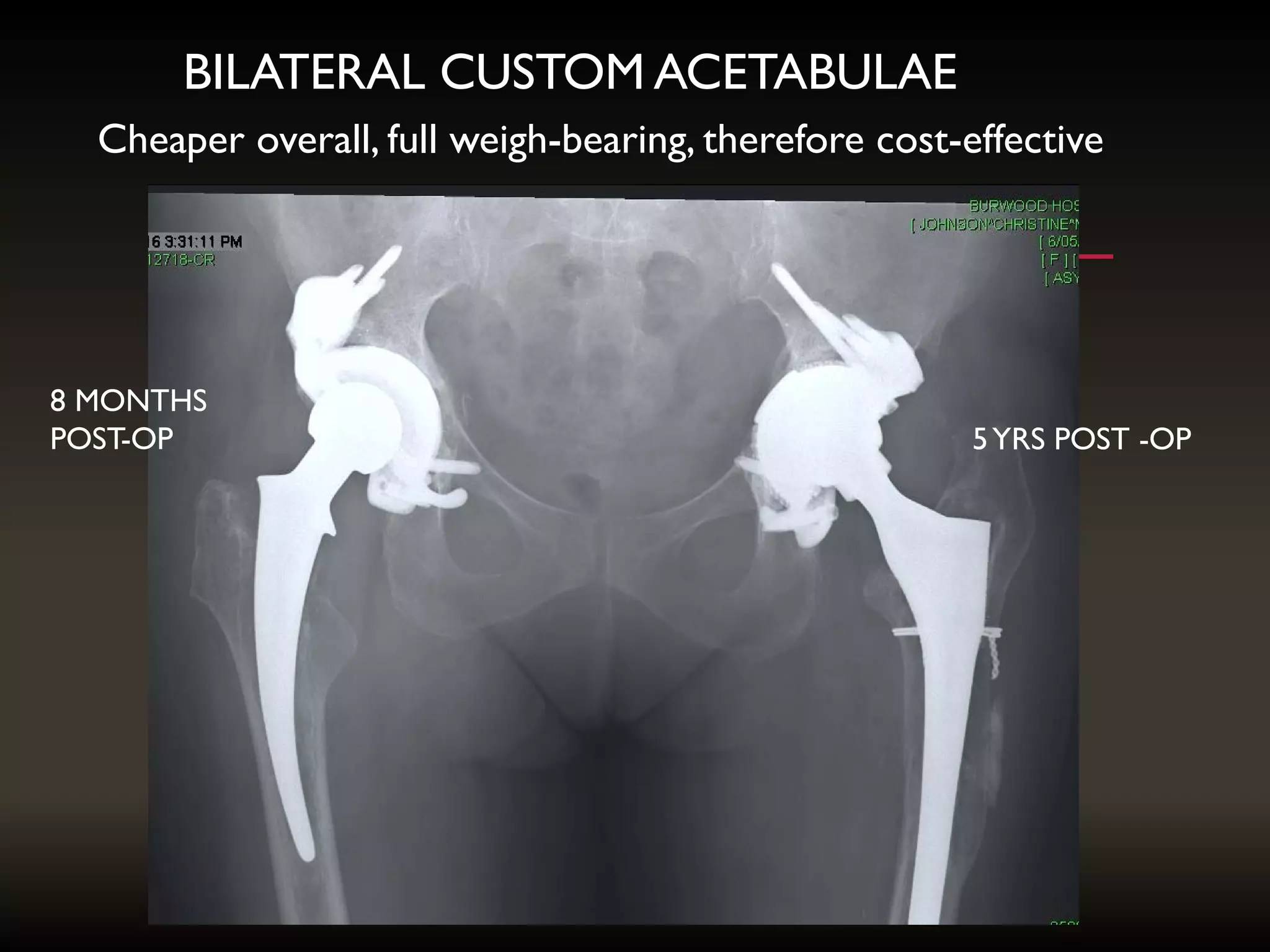BILATERAL CUSTOM ACETABULAE
5YRS POST -OP
8 MONTHS
POST-OP
Cheaper overall, full weigh-bearing, therefore cost-effective
 