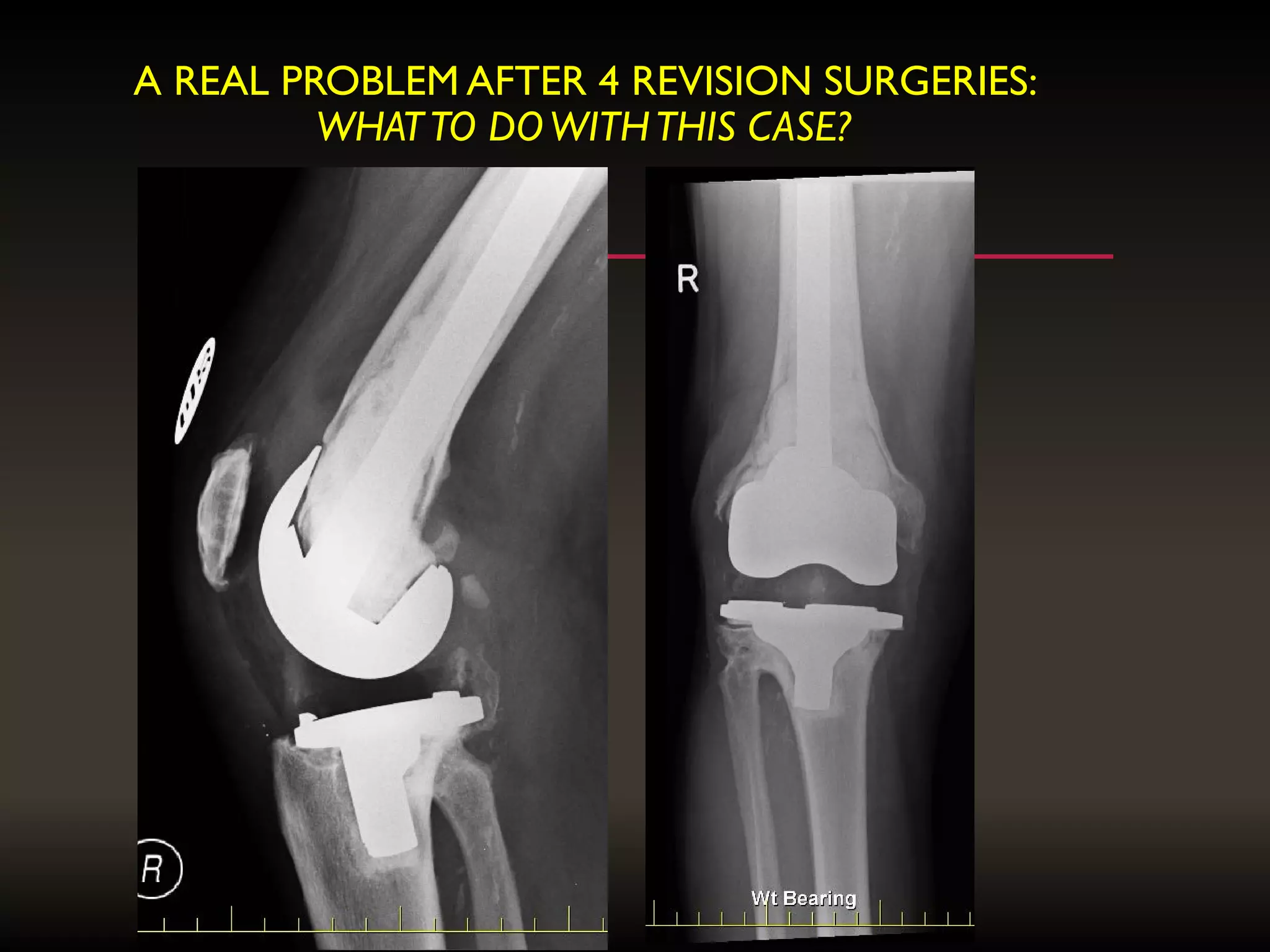 A REAL PROBLEM AFTER 4 REVISION SURGERIES:
WHATTO DOWITHTHIS CASE?
 