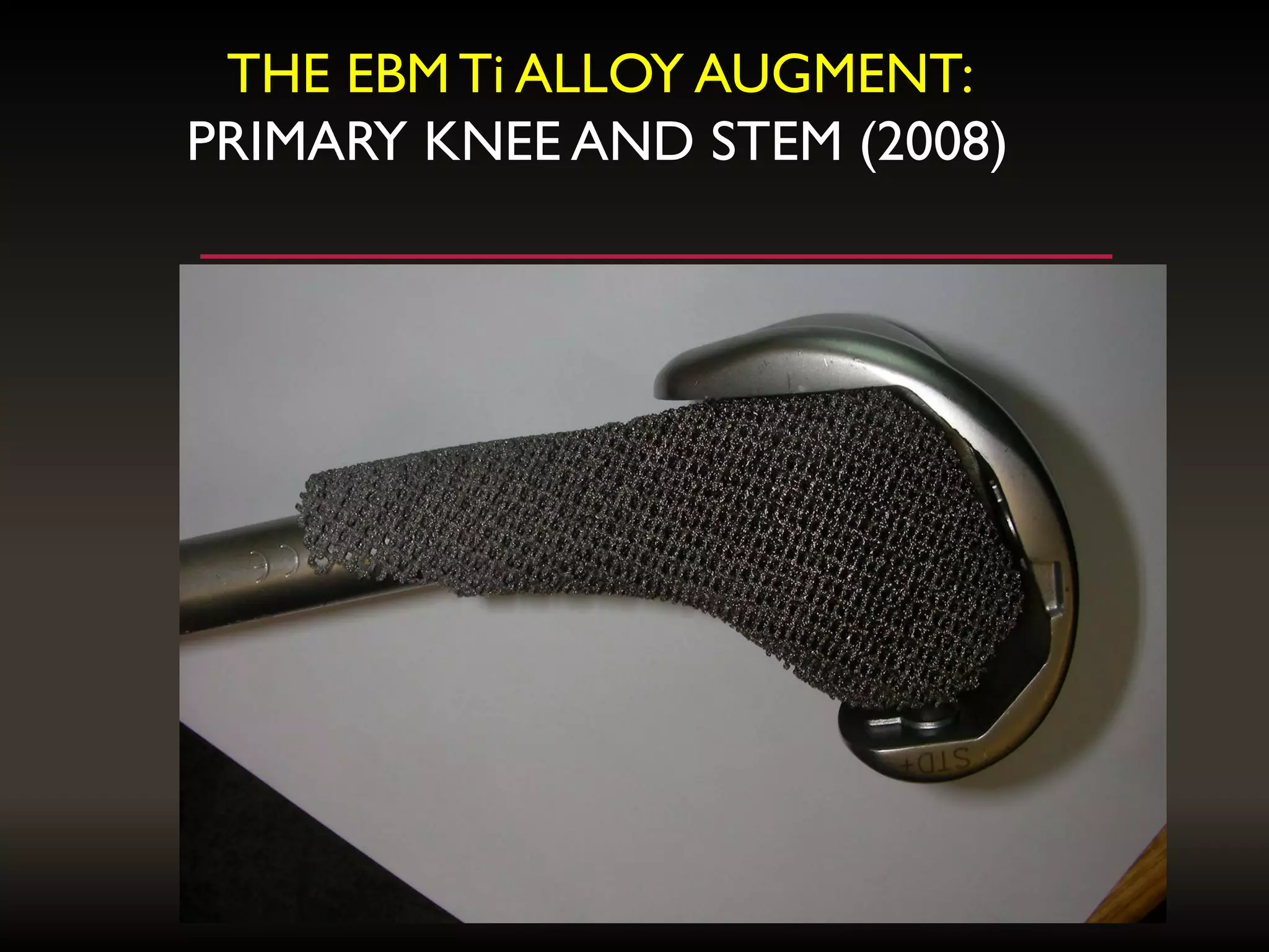 THE EBMTi ALLOY AUGMENT:
PRIMARY KNEE AND STEM (2008)
 