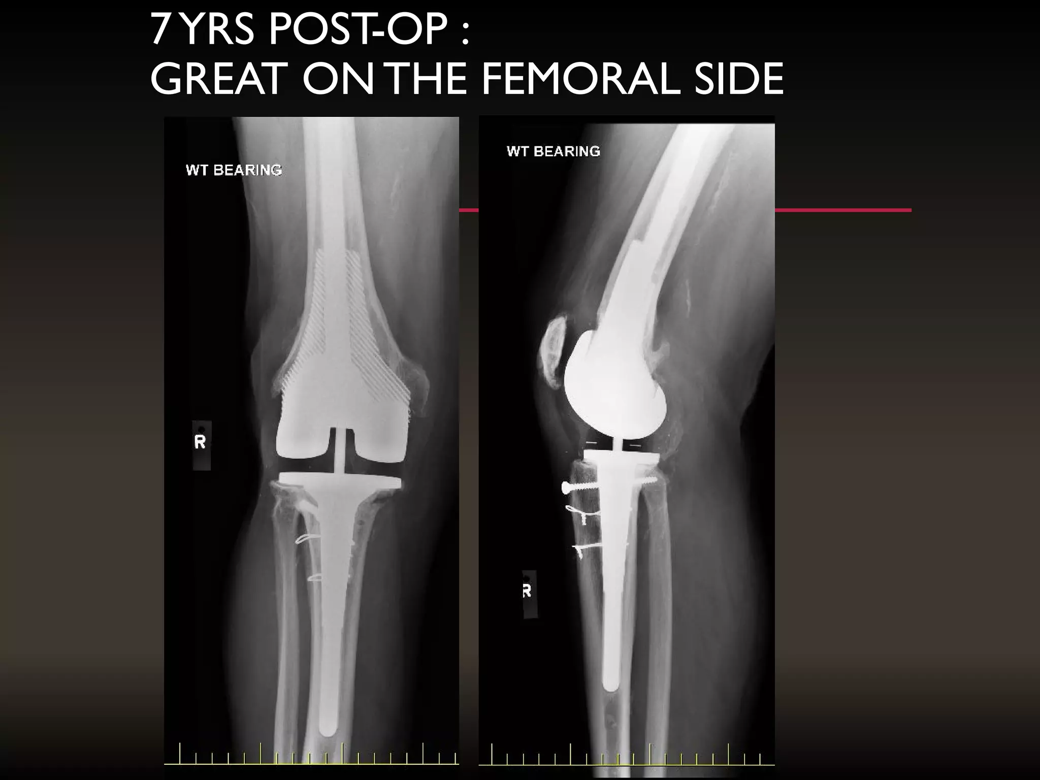 7YRS POST-OP :
GREAT ONTHE FEMORAL SIDE
 
