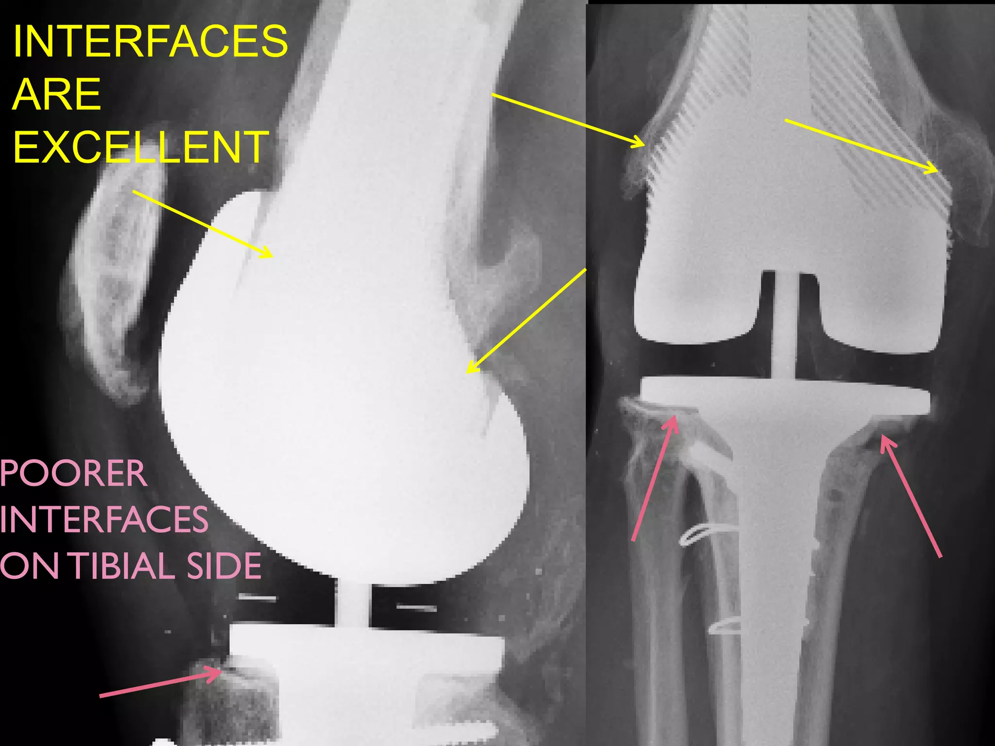 INTERFACES
ARE
EXCELLENT
POORER
INTERFACES
ON TIBIAL SIDE
 