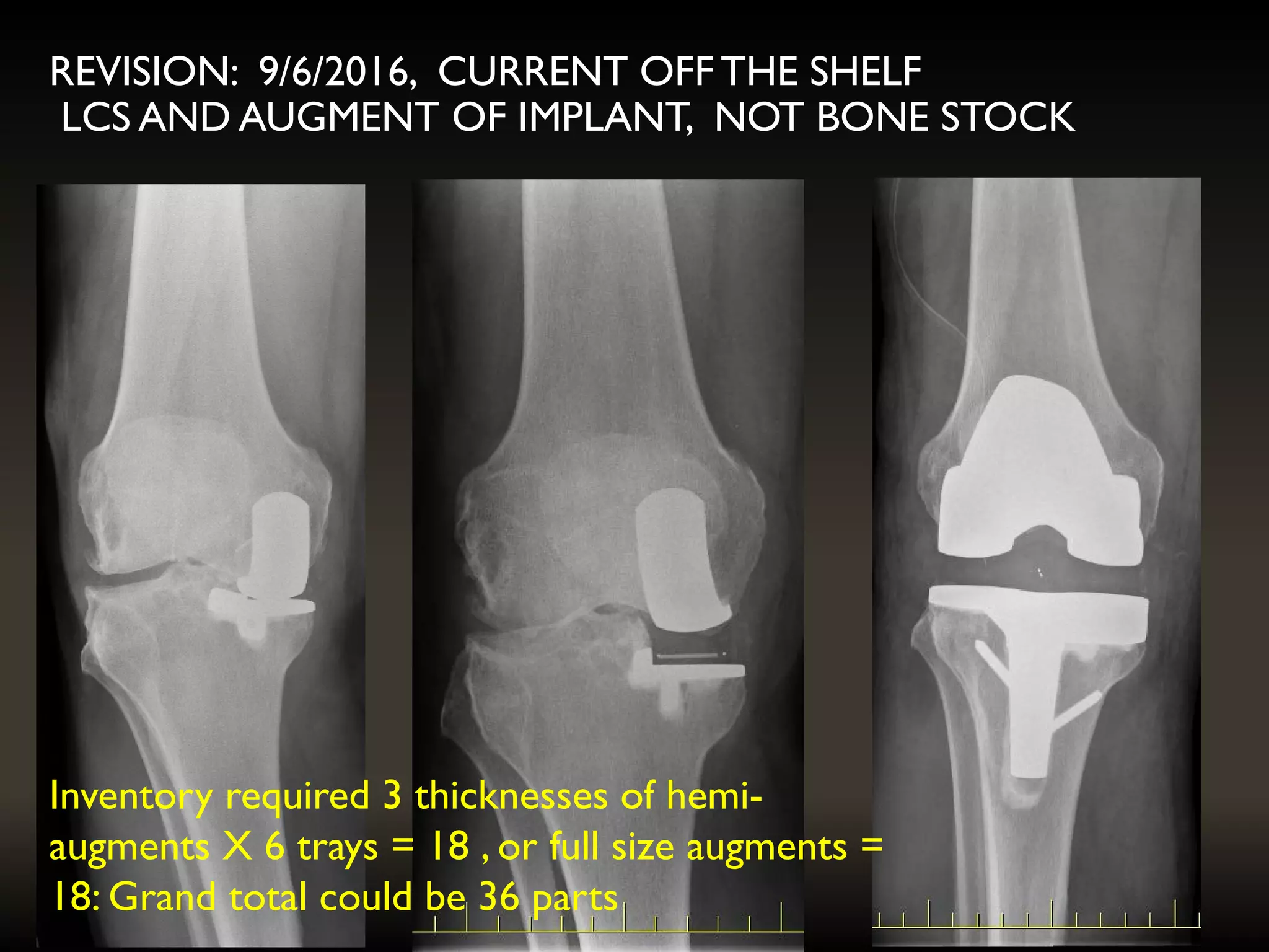 Inventory required 3 thicknesses of hemi-
augments X 6 trays = 18 , or full size augments =
18: Grand total could be 36 parts
REVISION: 9/6/2016, CURRENT OFF THE SHELF
LCS AND AUGMENT OF IMPLANT, NOT BONE STOCK
 