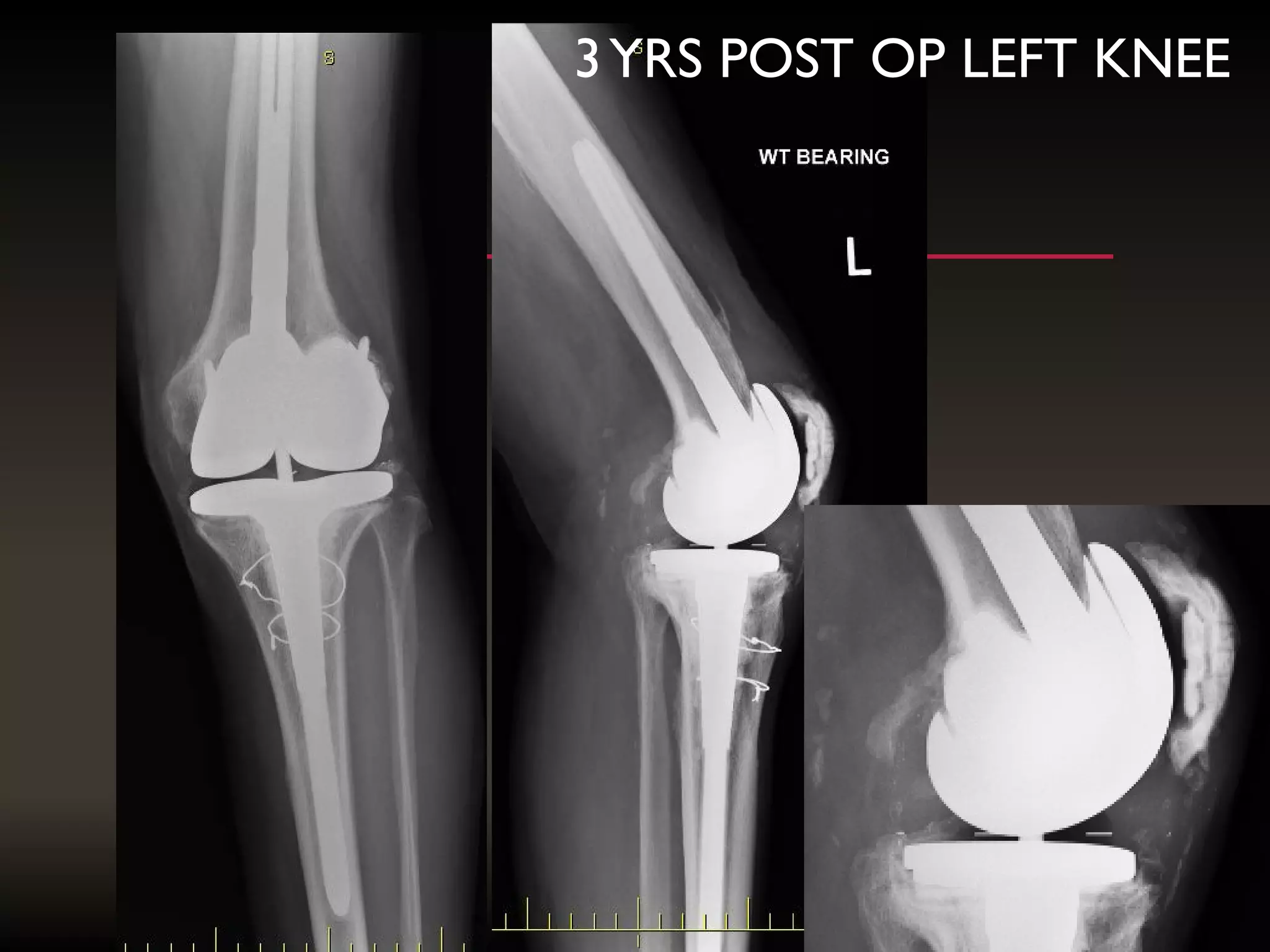 3YRS POST OP LEFT KNEE
 