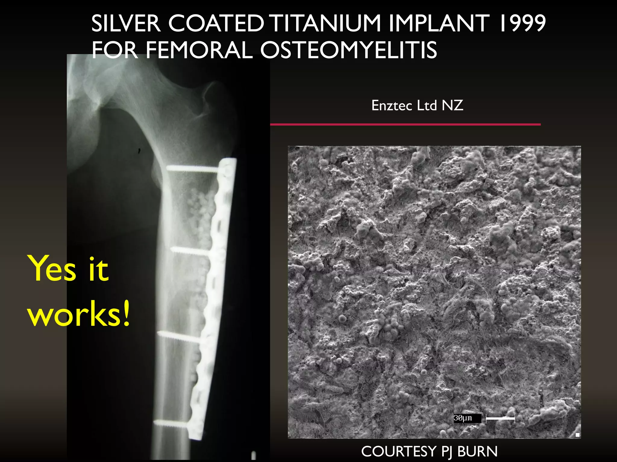 SILVER COATEDTITANIUM IMPLANT 1999
FOR FEMORAL OSTEOMYELITIS
COURTESY PJ BURN
Enztec Ltd NZ
Yes it
works!
 