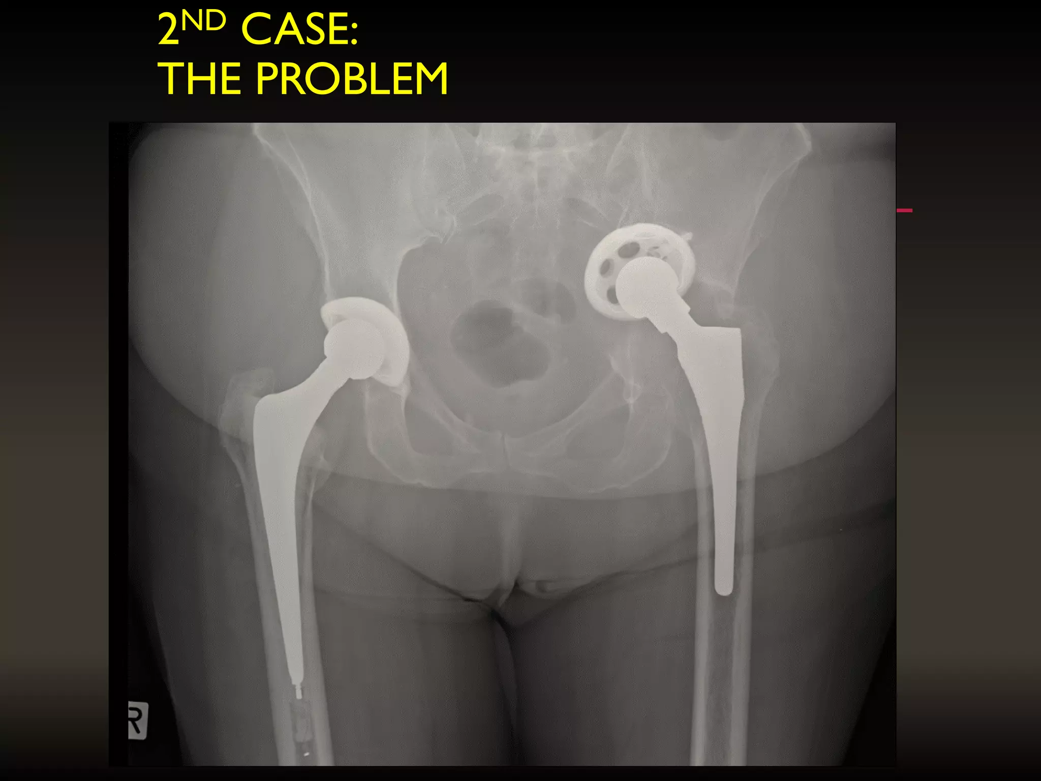 2ND CASE:
THE PROBLEM
 