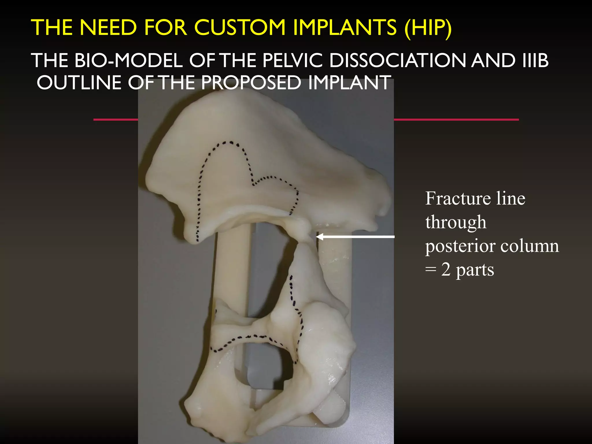 THE BIO-MODEL OF THE PELVIC DISSOCIATION AND IIIB
OUTLINE OF THE PROPOSED IMPLANT
Fracture line
through
posterior column
= 2 parts
THE NEED FOR CUSTOM IMPLANTS (HIP)
 