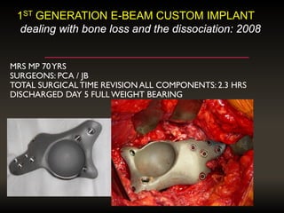 MRS MP 70YRS
SURGEONS: PCA / JB
TOTAL SURGICAL TIME REVISION ALL COMPONENTS: 2.3 HRS
DISCHARGED DAY 5 FULL WEIGHT BEARING
1ST GENERATION E-BEAM CUSTOM IMPLANT
dealing with bone loss and the dissociation: 2008
 