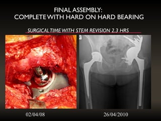 FINAL ASSEMBLY:
COMPLETEWITH HARD ON HARD BEARING
SURGICALTIMEWITH STEM REVISION 2.3 HRS
02/04/08 26/04/2010
 