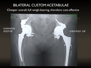 BILATERAL CUSTOM ACETABULAE
5YRS POST -OP
8 MONTHS
POST-OP
Cheaper overall, full weigh-bearing, therefore cost-effective
 