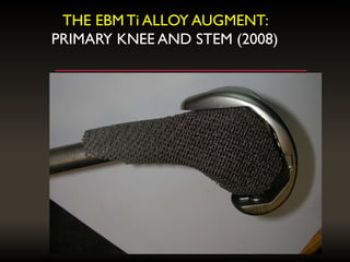THE EBMTi ALLOY AUGMENT:
PRIMARY KNEE AND STEM (2008)
 