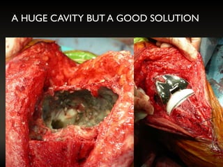 A HUGE CAVITY BUT A GOOD SOLUTION
 