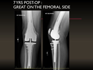 7YRS POST-OP :
GREAT ONTHE FEMORAL SIDE
 