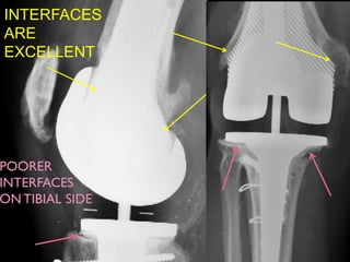 INTERFACES
ARE
EXCELLENT
POORER
INTERFACES
ON TIBIAL SIDE
 