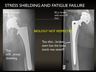 STRESS SHIELDING AND FATIGUE FAILURE
Too
stiff...stress
shielding
Too thin... broken
stem but the bone
stock was saved!!
82 yr female
with worn PE
liner
82 yr male with
thigh pain
BIOLOGY NOT RESPECTED
 