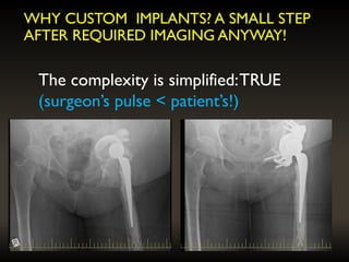 WHY CUSTOM IMPLANTS? A SMALL STEP
AFTER REQUIRED IMAGING ANYWAY!
The complexity is simplified:TRUE
(surgeon’s pulse < patient’s!)
 