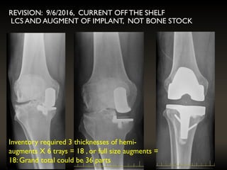 Inventory required 3 thicknesses of hemi-
augments X 6 trays = 18 , or full size augments =
18: Grand total could be 36 parts
REVISION: 9/6/2016, CURRENT OFF THE SHELF
LCS AND AUGMENT OF IMPLANT, NOT BONE STOCK
 