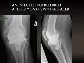 AN INFECTEDTKR REFERRED
AFTER 8 MONTHS WITH A SPACER
 