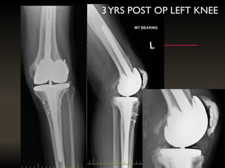3YRS POST OP LEFT KNEE
 