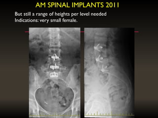 AM SPINAL IMPLANTS 2011
But still a range of heights per level needed
Indications: very small female.
 